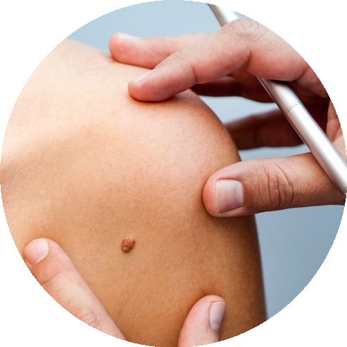 Laserowe usuwanie blizn, pieprzyków i znamion