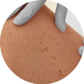Choroby dermatologiczne
