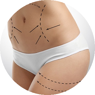 Liposukcja