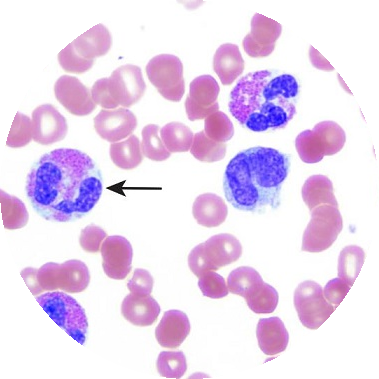 chlamydioza przyczyny