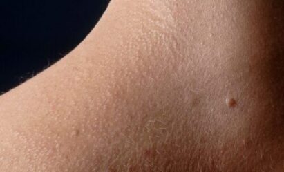 Objawy liszaja płaskiego