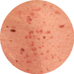 Objawy liszaja płaskiego