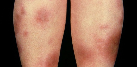 Objawy rumienia guzowatego