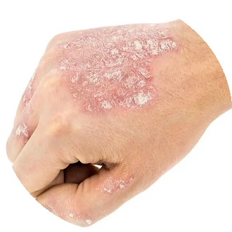 Powikłania łuszczycy