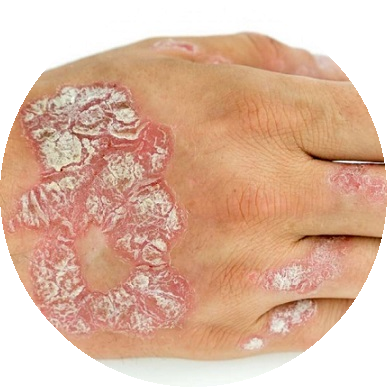 Przyczyny łuszczycy