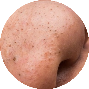 Jak usunąć zaskórniki ze skóry?