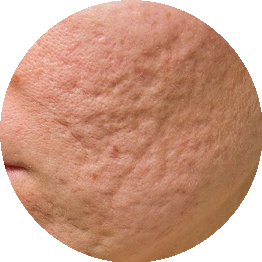 Blizny potrądzikowe - jak sobie z nimi radzić