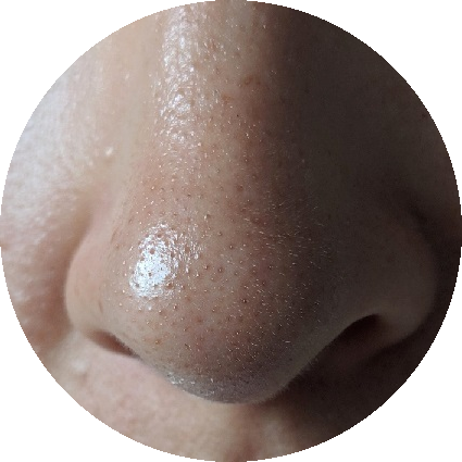 Sebum na nosie